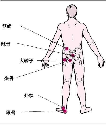 褥疮常见发病部位:骶尾部褥疮的治疗方法是什么