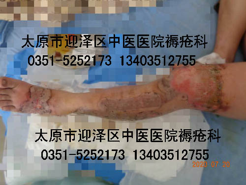 山西太原樊某某左下肢及双足火油烫伤治疗病例