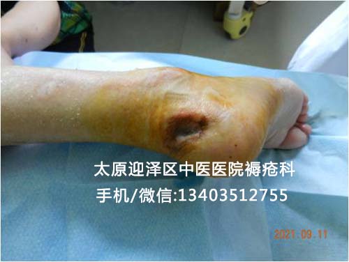 忻州冯某某右侧跟骨皮肤破溃的治疗病例