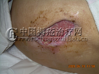 河北张某褥疮的典型病例