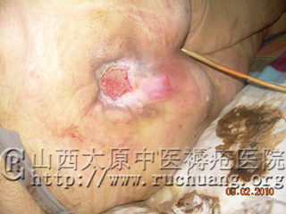 老年人褥疮用什么药治疗有效(图)